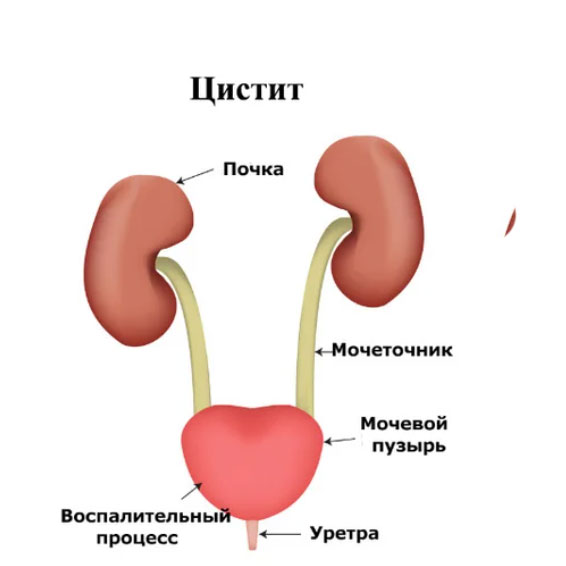 Цистит заболевание